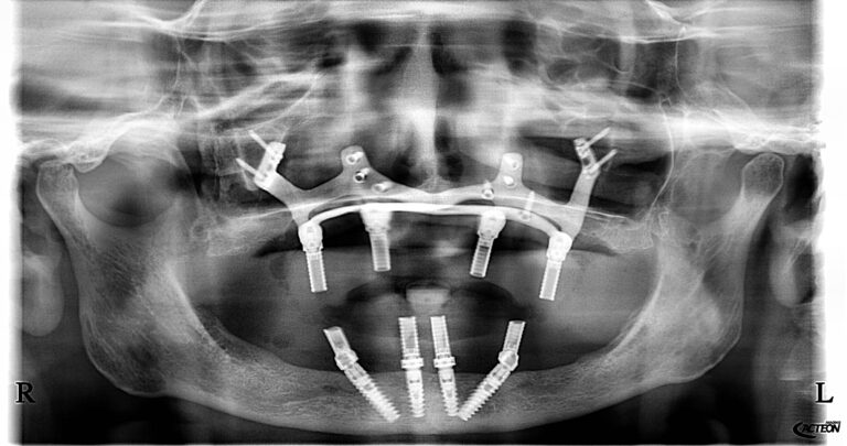 Röntgenbild PSI-Konstruktion im Oberkiefer mit Implantaten
